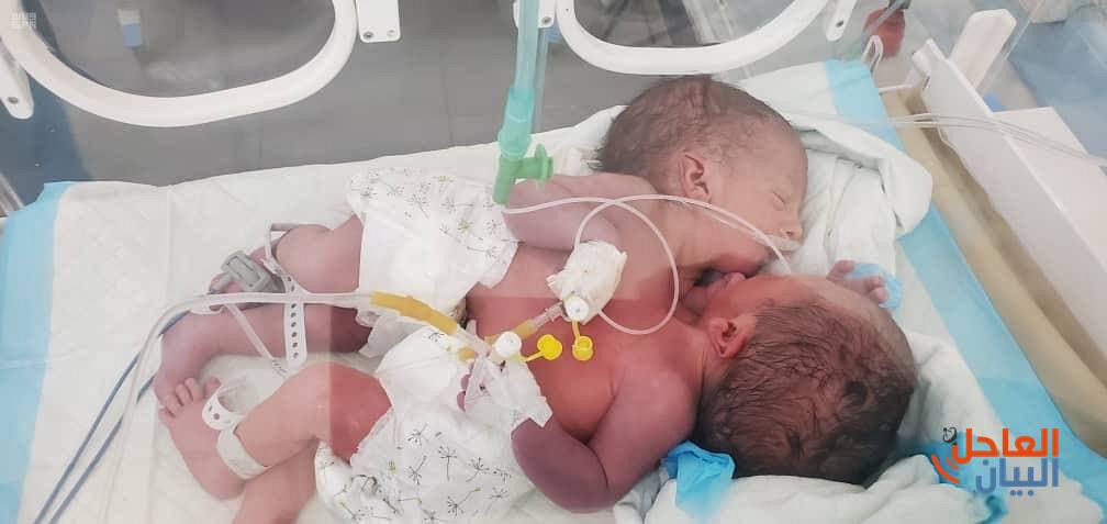لاستجابة مركز الملك سلمان للإغاثة للحالة الإنسانية للتوأم السيامي اليمني في مستشفى السبعين بصنعاء