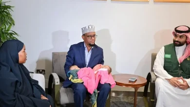 التوأم الملتصق