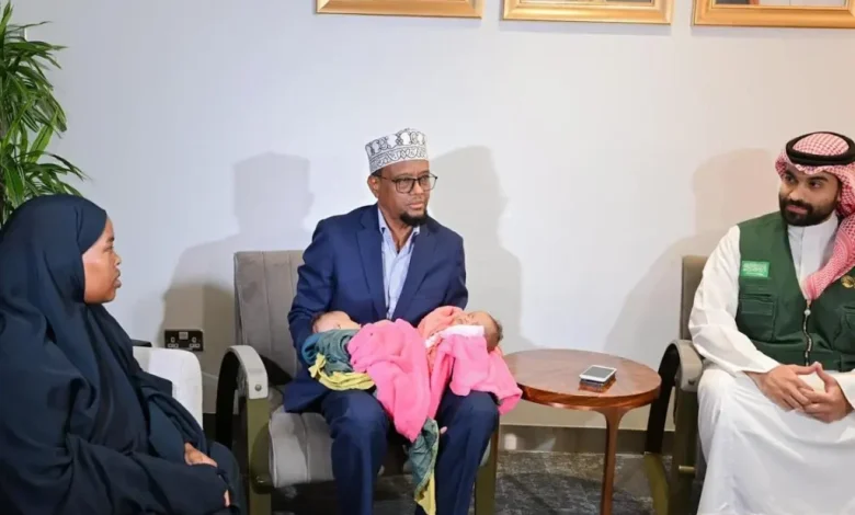 التوأم الملتصق